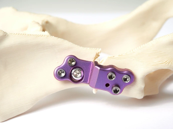 TackTec implant plate on bone model